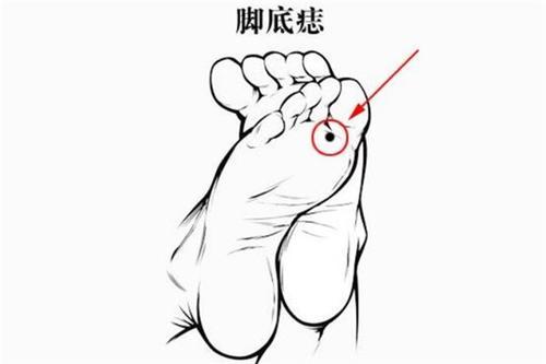 女人右脚底有痣好不好
