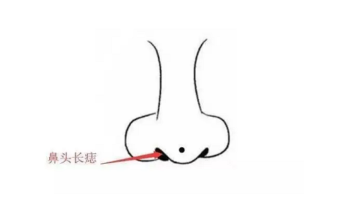 男人鼻子上有痣图解