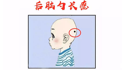 后脑勺下面有痣代表什么