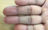 十指全是簸箕的是帝王命吗？十指全是斗命运如何